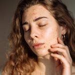 Czy peeling laserowy może usunąć blizny potrądzikowe