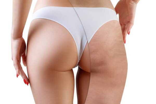 Czy można usunąć cellulit bez ćwiczeń i diety